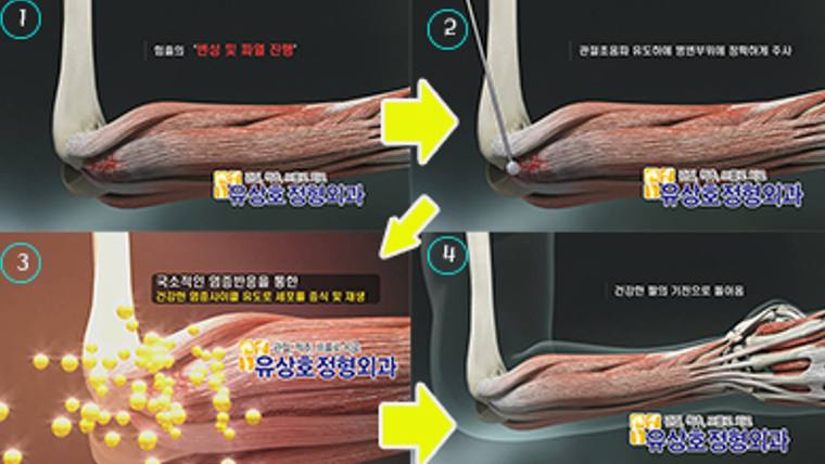 유상호정형외과의원 — 네 단계의 과정을 설명하는 텍스트와 근육 및 관절 구조를 나타낸 의학적 일러스트레이션이 포함된 홍보용 이미지입니다