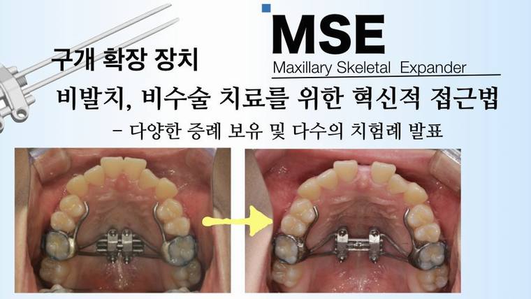 구개 확장 장치와 관련한 의료 정보 및 사례를 설명하는 홍보용 포스터 이미지이다.